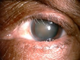 Surgical and para-surgical techniques for correction of trichiasis and entropion: under-recognized contribution of ancient India