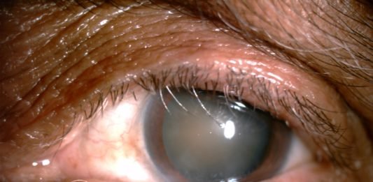 Surgical and para-surgical techniques for correction of trichiasis and entropion: under-recognized contribution of ancient India