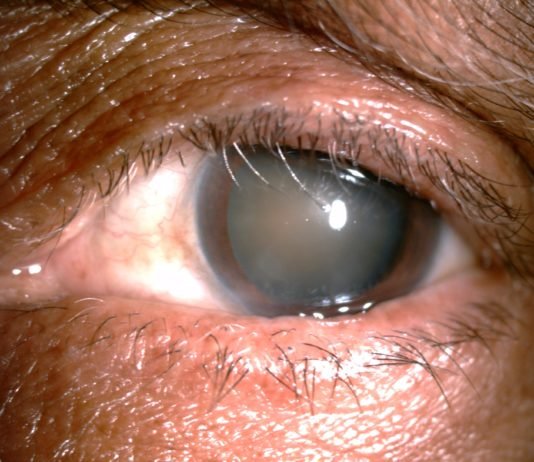 Surgical and para-surgical techniques for correction of trichiasis and entropion: under-recognized contribution of ancient India